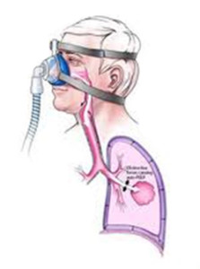 non-invasive-ventilation