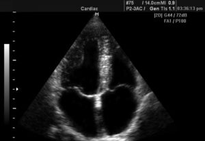 Apical4ChamberCROP